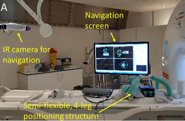 Système de navigation chirurgicale avec caméra infrarouge et écran de contrôle utilisé dans le projet UFOGUIDE pour traiter les tumeurs osseuses